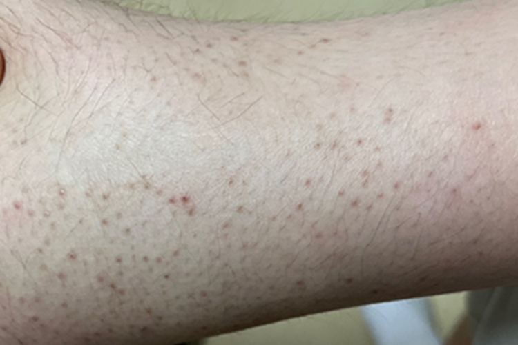 毛囊角化病小腿红点图