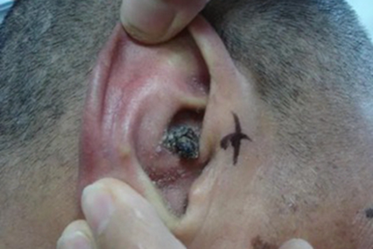 色素型基底细胞癌耳部症状图