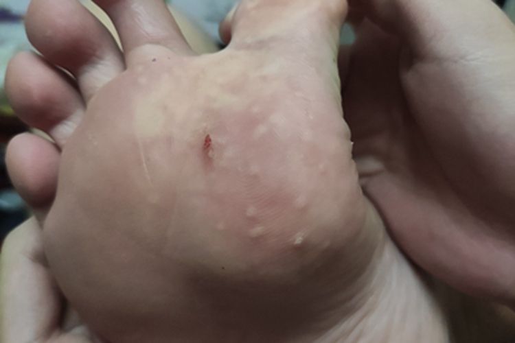 汗疱疹脚底症状图 汗疱疹脚底症状图