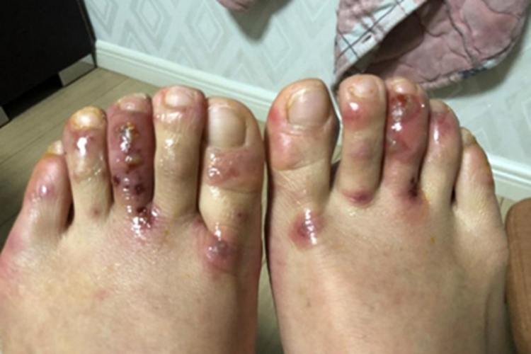 寒冷性多形红斑丘疹图