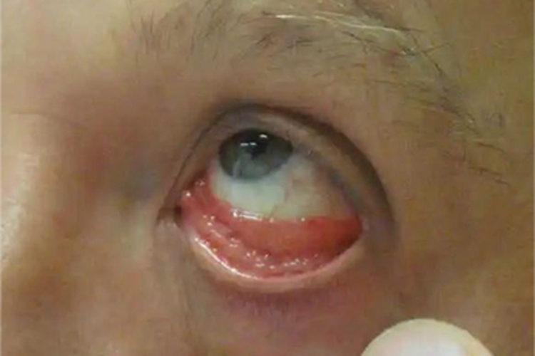 眼眶淋巴瘤眼部肿块图