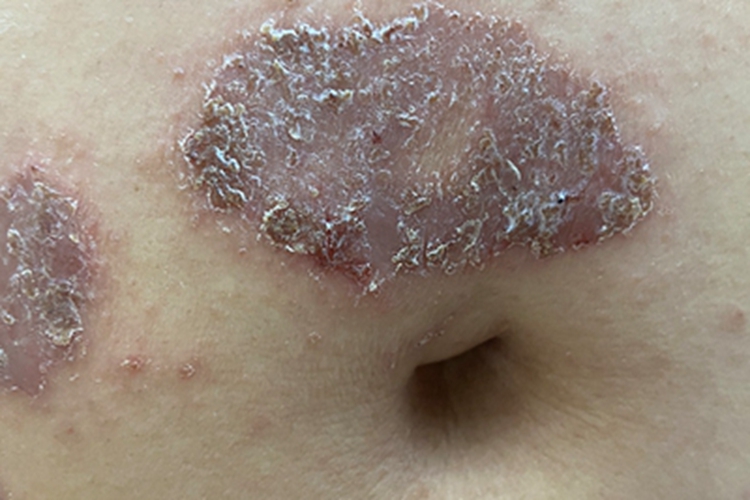 慢性湿疹腹部结痂图 慢性湿疹腹部结痂图