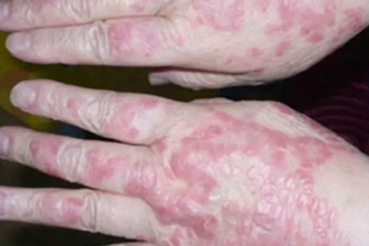 慢性黏膜皮肤念珠菌病手背红斑图 慢性黏膜皮肤念珠菌病手背红斑图