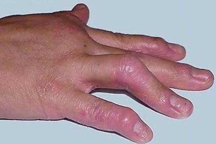 关节型银屑病图