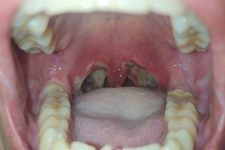 术后6小时开始长白膜图 术后6小时开始长白膜图