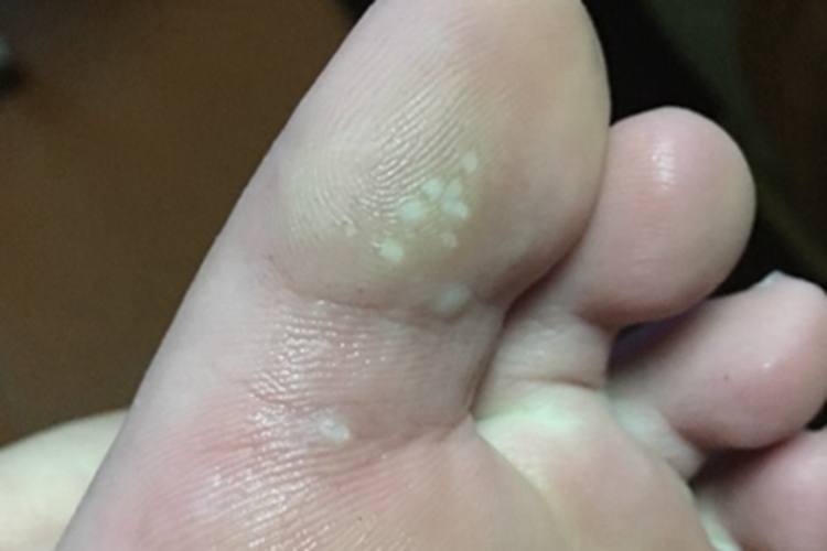 脚趾长水疱像一堆白点图