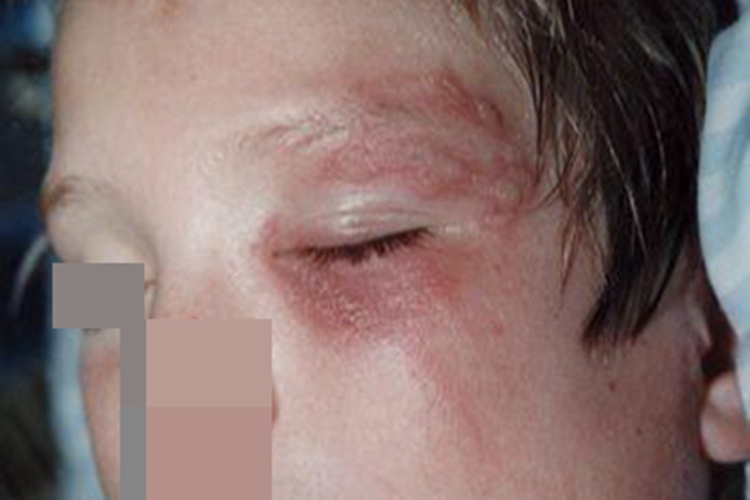 植物性皮炎眼周红斑图 植物性皮炎眼周红斑图