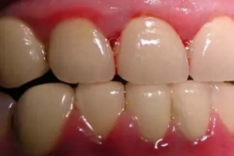 维生素c缺乏症牙龈症状图