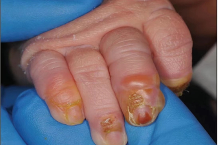 脓疱疮水疱图 脓疱疮水疱图