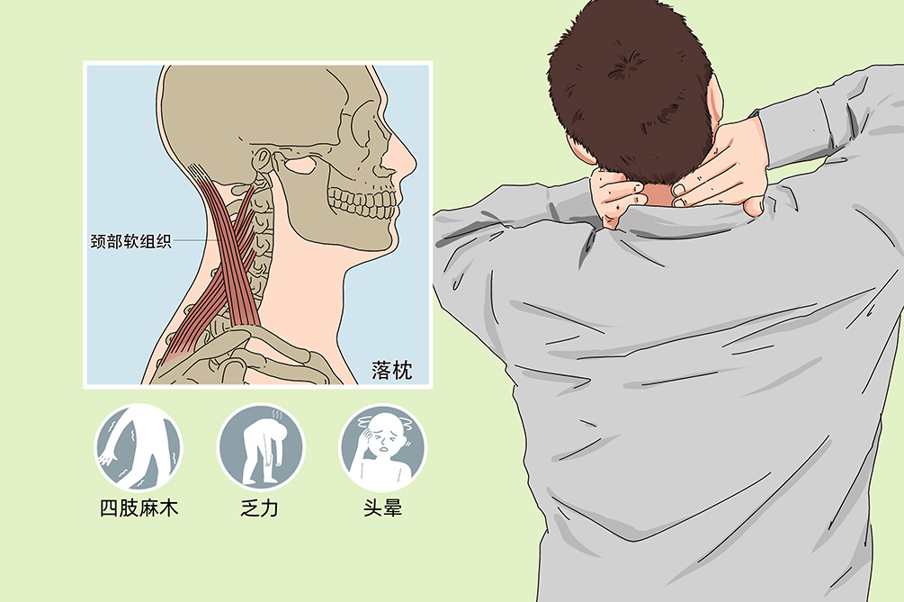 落枕
