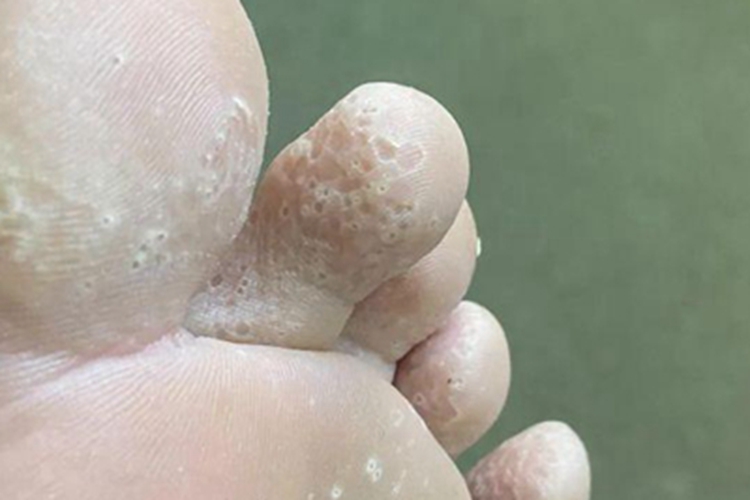 窝状角质松解症小坑图 窝状角质松解症小坑图