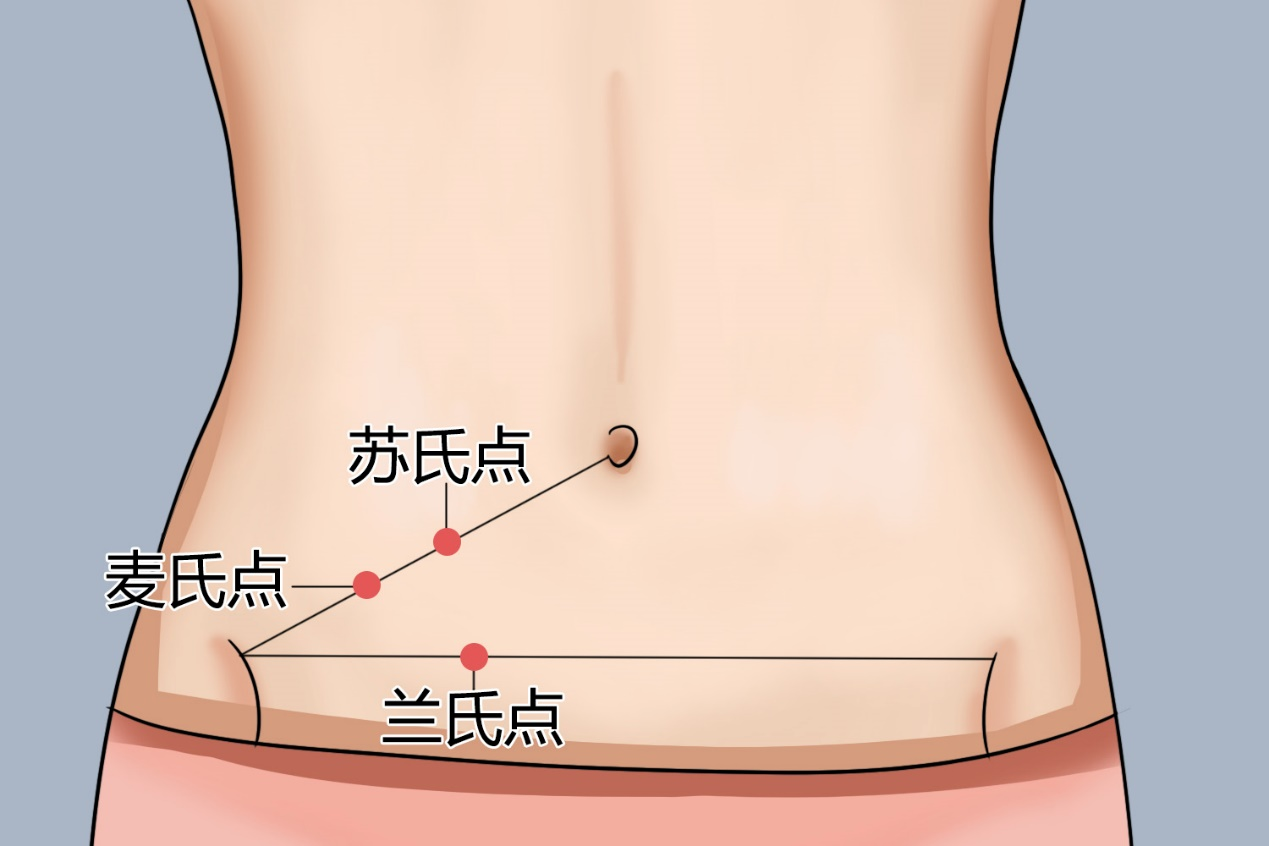 女性阑尾炎压痛点位置图
