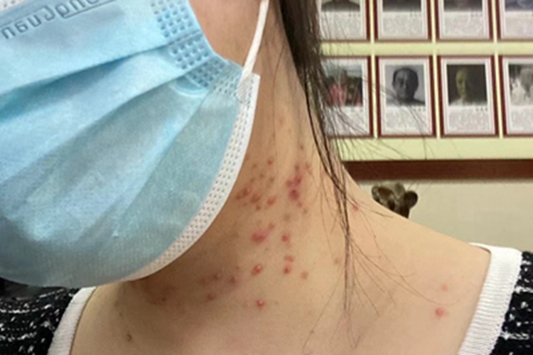 马拉色菌毛囊炎侧颈脓包图 马拉色菌毛囊炎侧颈脓包图