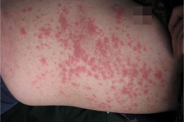 螨虫皮炎肋部症状图