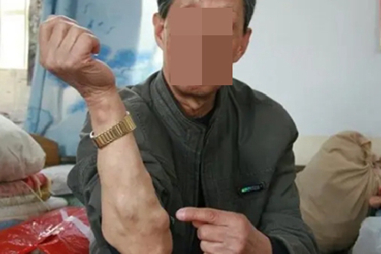 皮肤猪囊尾蚴病大包图