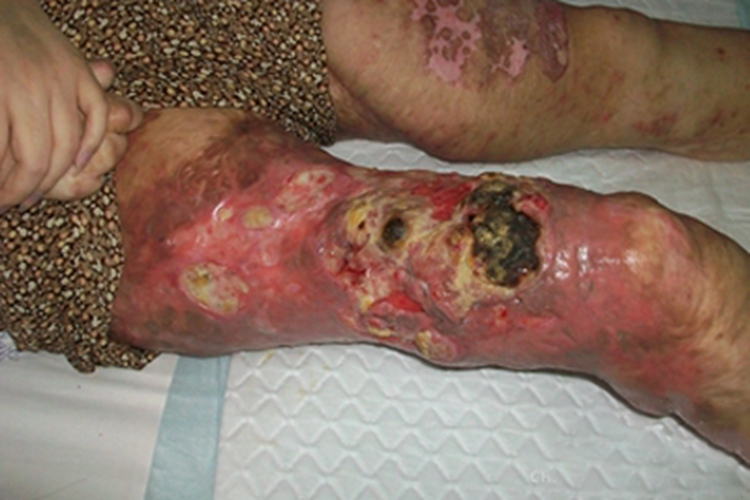 湿性坏疽糜烂图