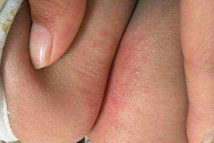 尿布皮炎屁股两侧有红点图 尿布皮炎屁股两侧有红点图