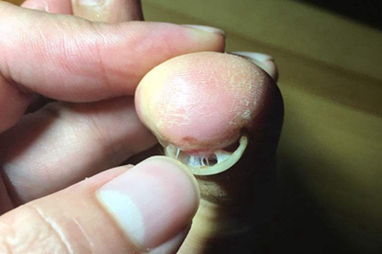 甲分离脚趾甲盖能掀起来图