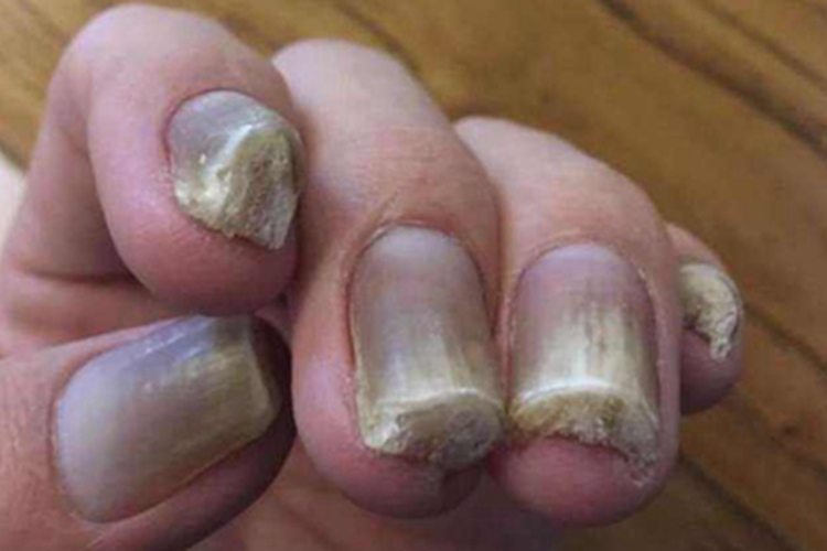 先天性厚甲症手指甲症状图