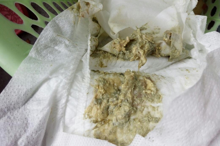 灰白色便 灰白色便