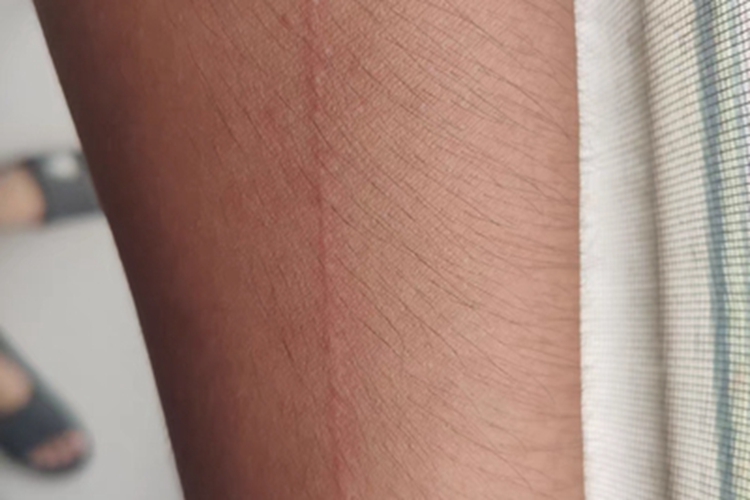 人工荨麻疹胳膊有划痕图 人工荨麻疹胳膊有划痕图