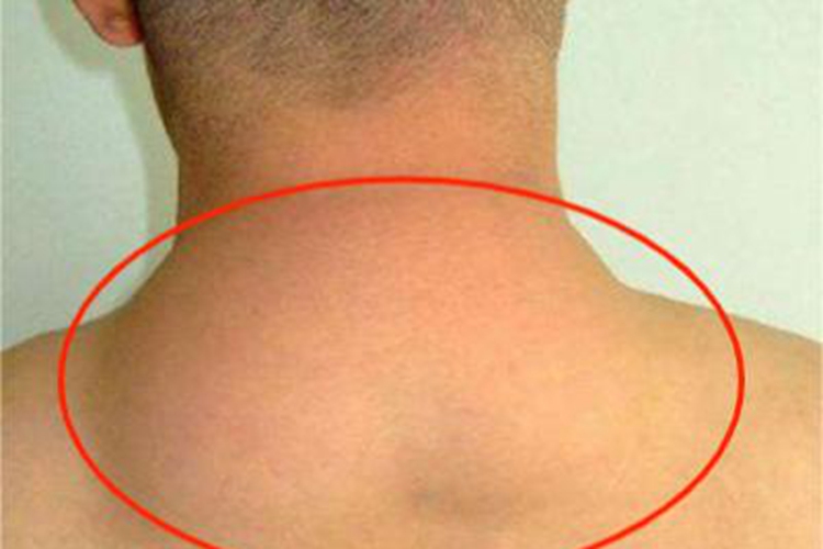 脂肪瘤后颈肿块图 脂肪瘤后颈肿块图