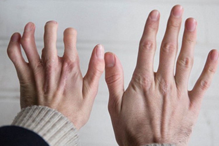 肩手综合征手指症状图