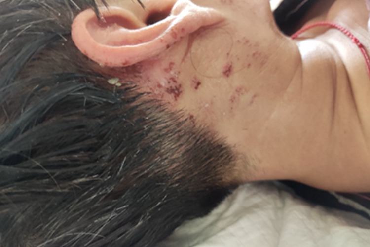 带状疱疹耳后结痂图