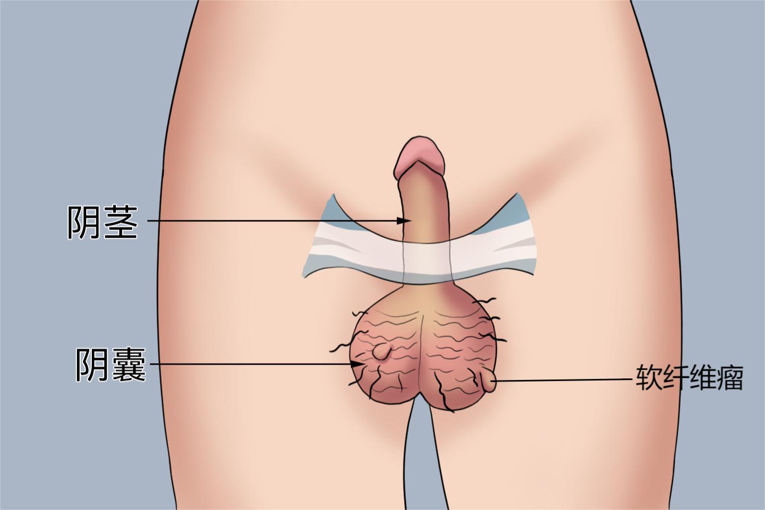 阴囊纤维瘤图片