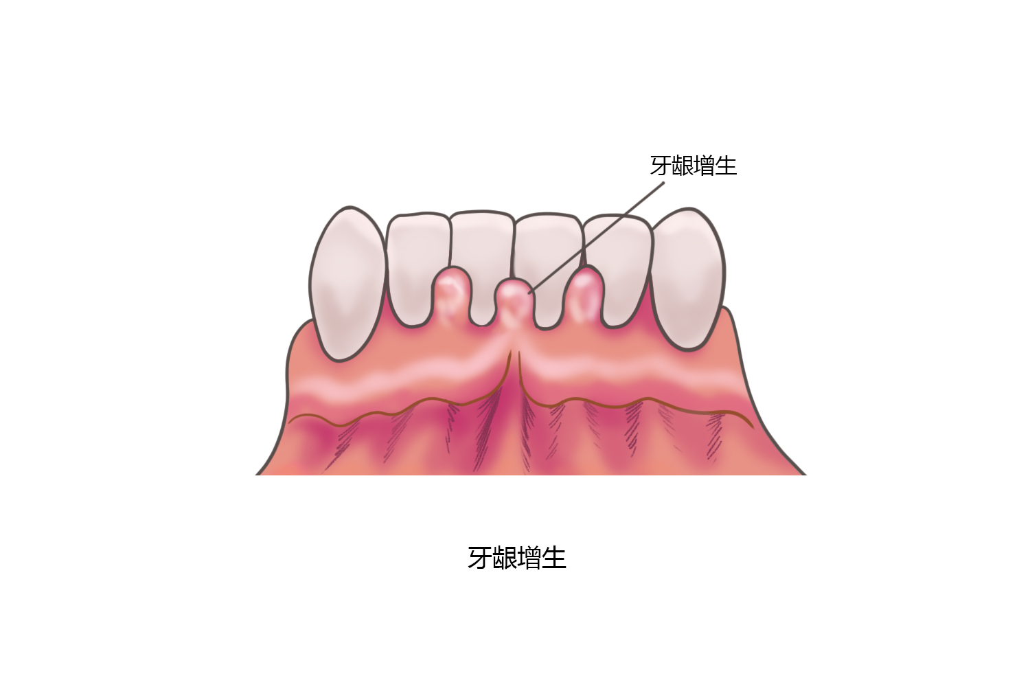 牙龈增生表现图