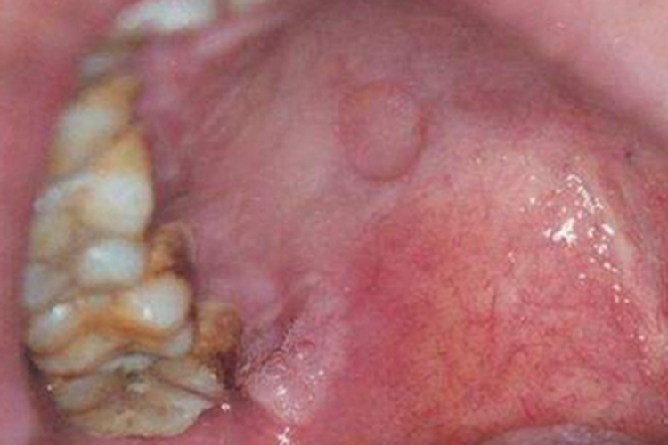 一期梅毒口腔症状图