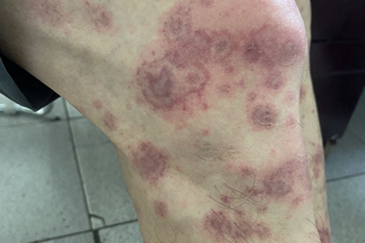 丘疹型轻型多形红斑症状图