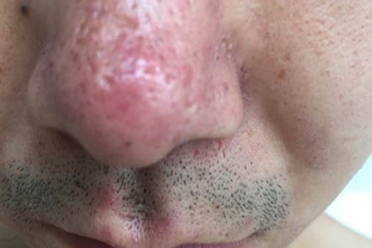 鼻赘型酒糟鼻鼻尖症状图