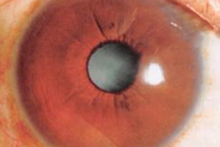 年龄相关性白内障斑图