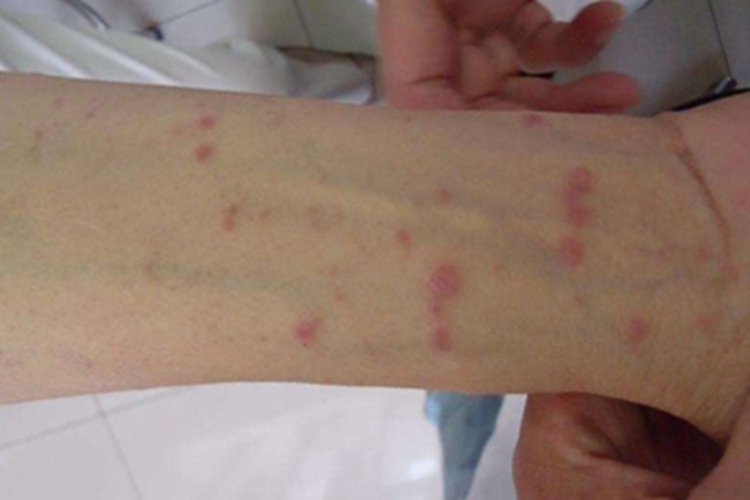 扁平苔藓胳膊淡红色丘疹图 扁平苔藓胳膊淡红色丘疹图