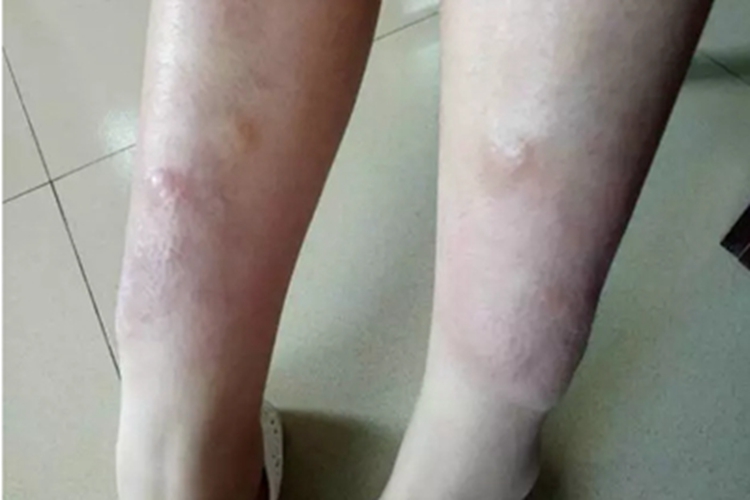 胫前黏液性水肿小腿水肿结节图