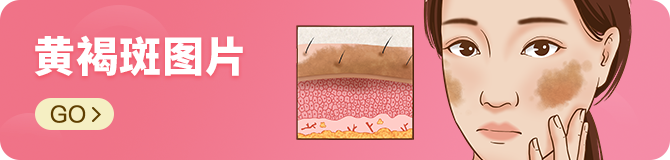 黄褐斑图片