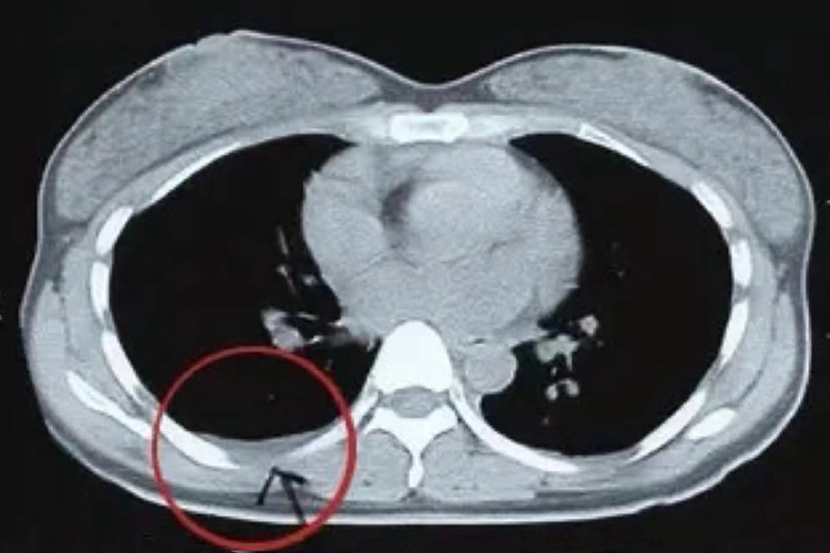 肋骨骨折CT图 肋骨骨折CT图