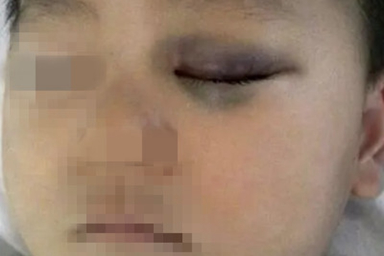 眼眶血肿眼皮发紫发青图 眼眶血肿眼皮发紫发青图