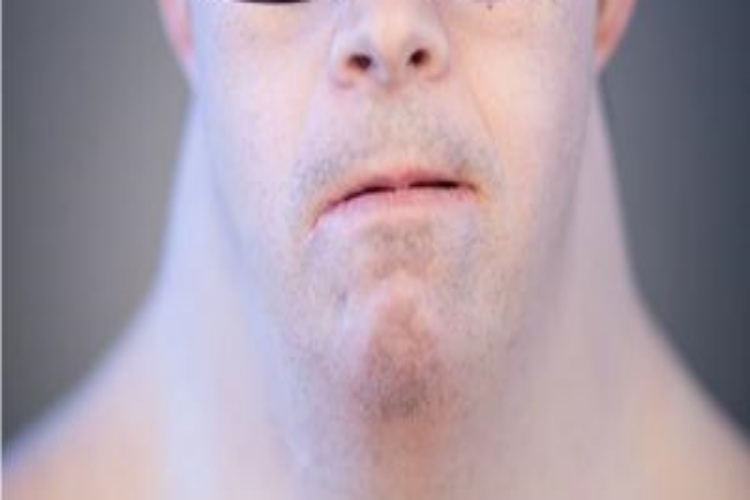 唐氏综合征颈部较粗图