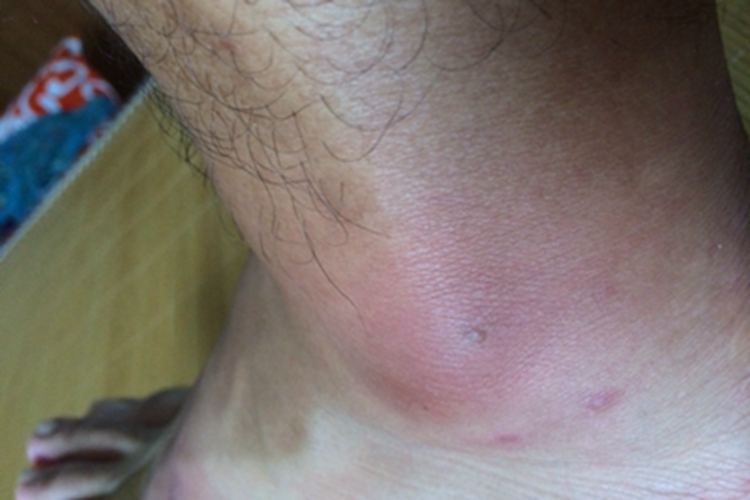 蚁蜇伤脚踝症状图