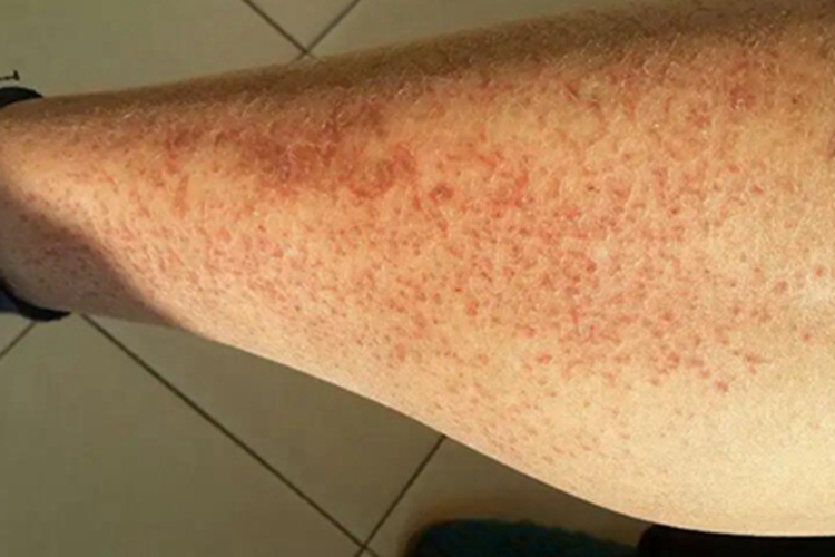 干性湿疹小腿干燥皲裂结痂图