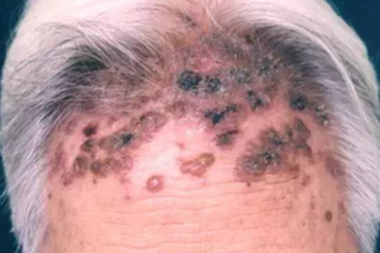 硬红斑前额结节溃疡图