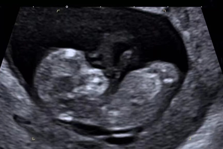 胎儿12周超声影像图