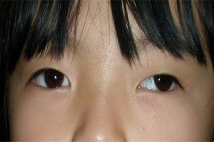 间歇性外斜视图