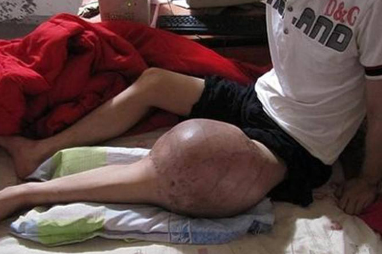 膝盖内侧骨肉瘤图