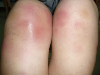 膝盖环形红斑图片