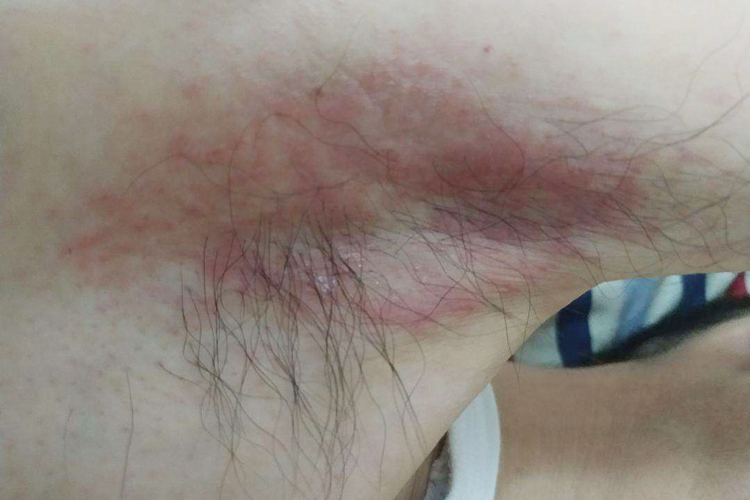 腋窝湿疹图