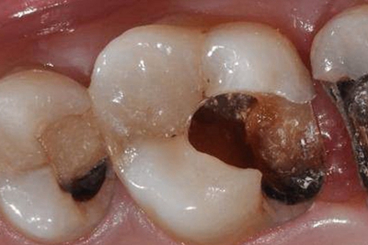 老年龋病深龋牙齿症状图