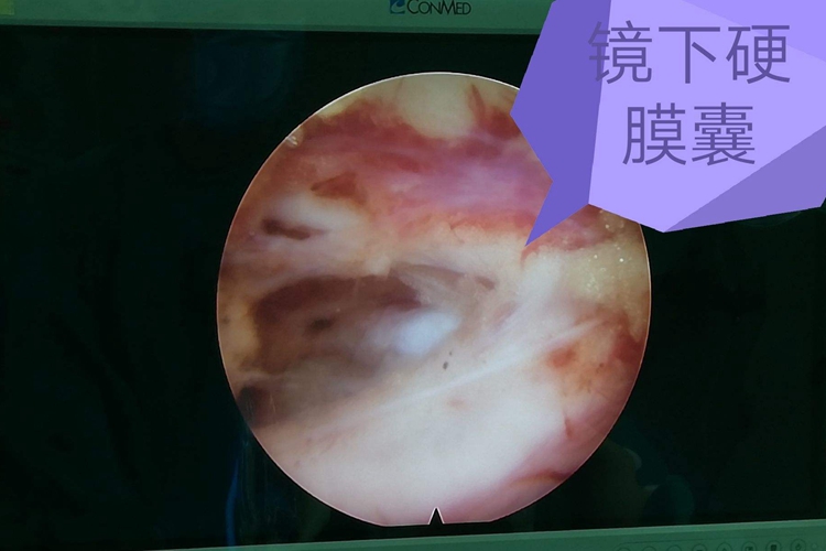 硬膜囊图 硬膜囊图